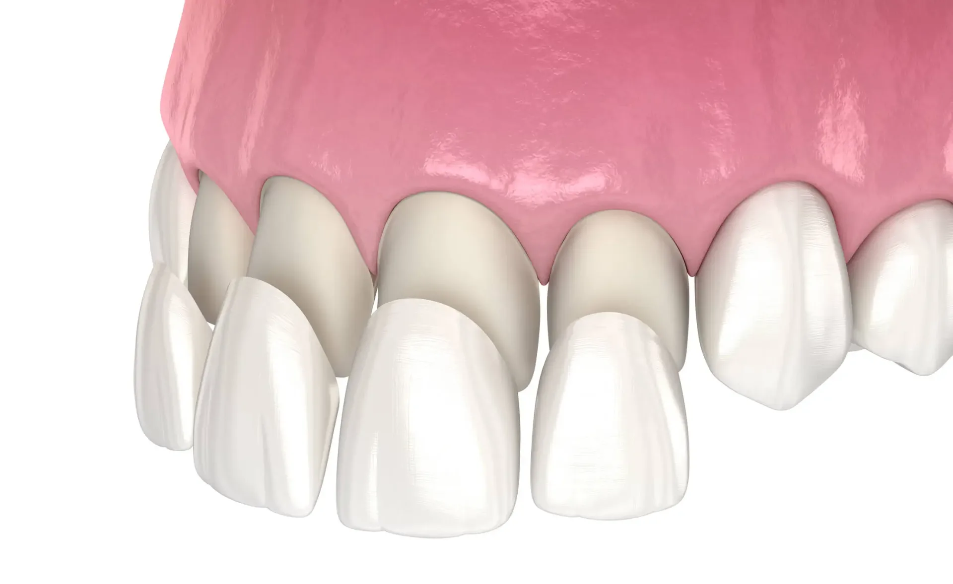 Illustration showing thin porcelain veneer shells being placed over the front of natural teeth